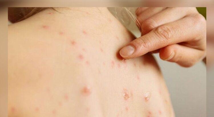 Primer caso confirmado de sarampión en Colima